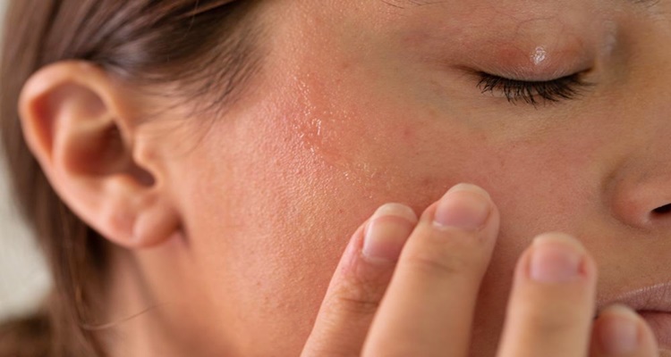 Mengembalikan Keseimbangan Kulit: Mengatasi Eksim dan Kulit Sensitif dengan Fensebiome™